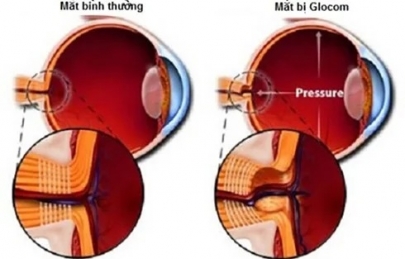 Glocom nhãn áp không cao: căn bệnh dễ gây mù lòa