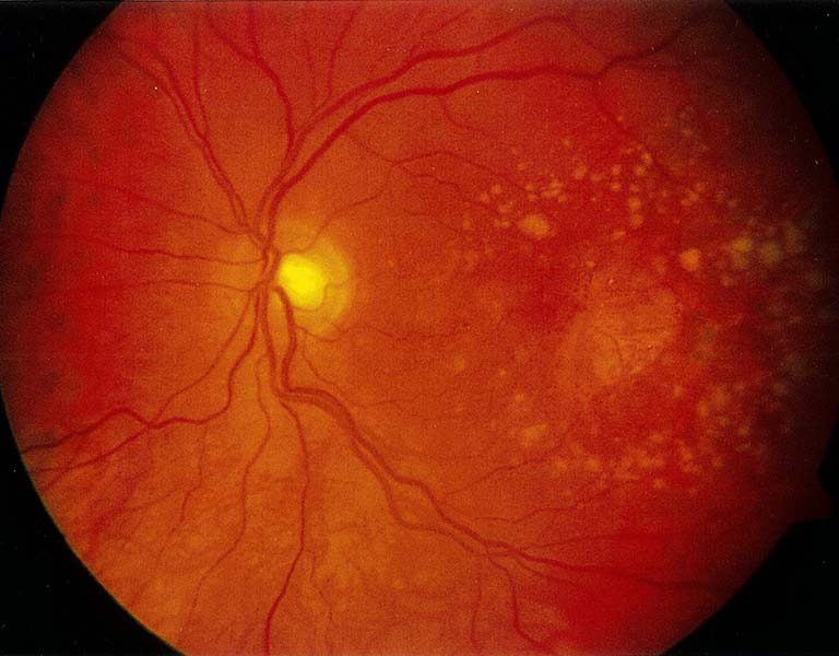 Thoái hóa điểm vàng thể khô